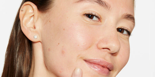 Here’s the difference between adult and teen breakouts