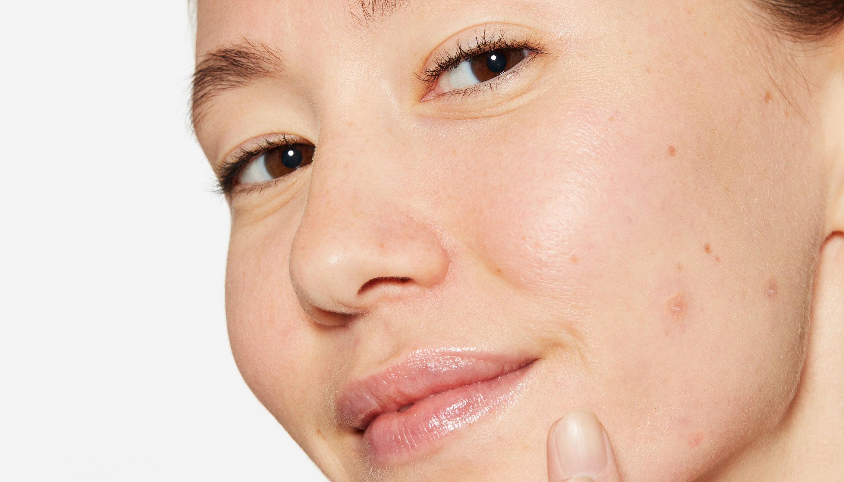 Types Of Spots And How To Treat Them – Dermalogica UK