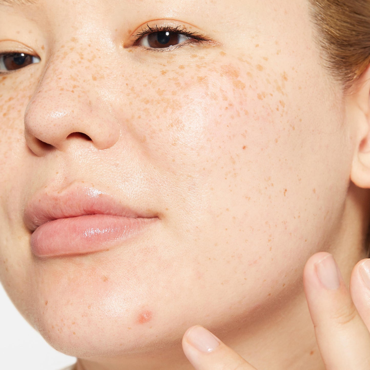 There's A Difference Between Spots And Acne? – Dermalogica UK