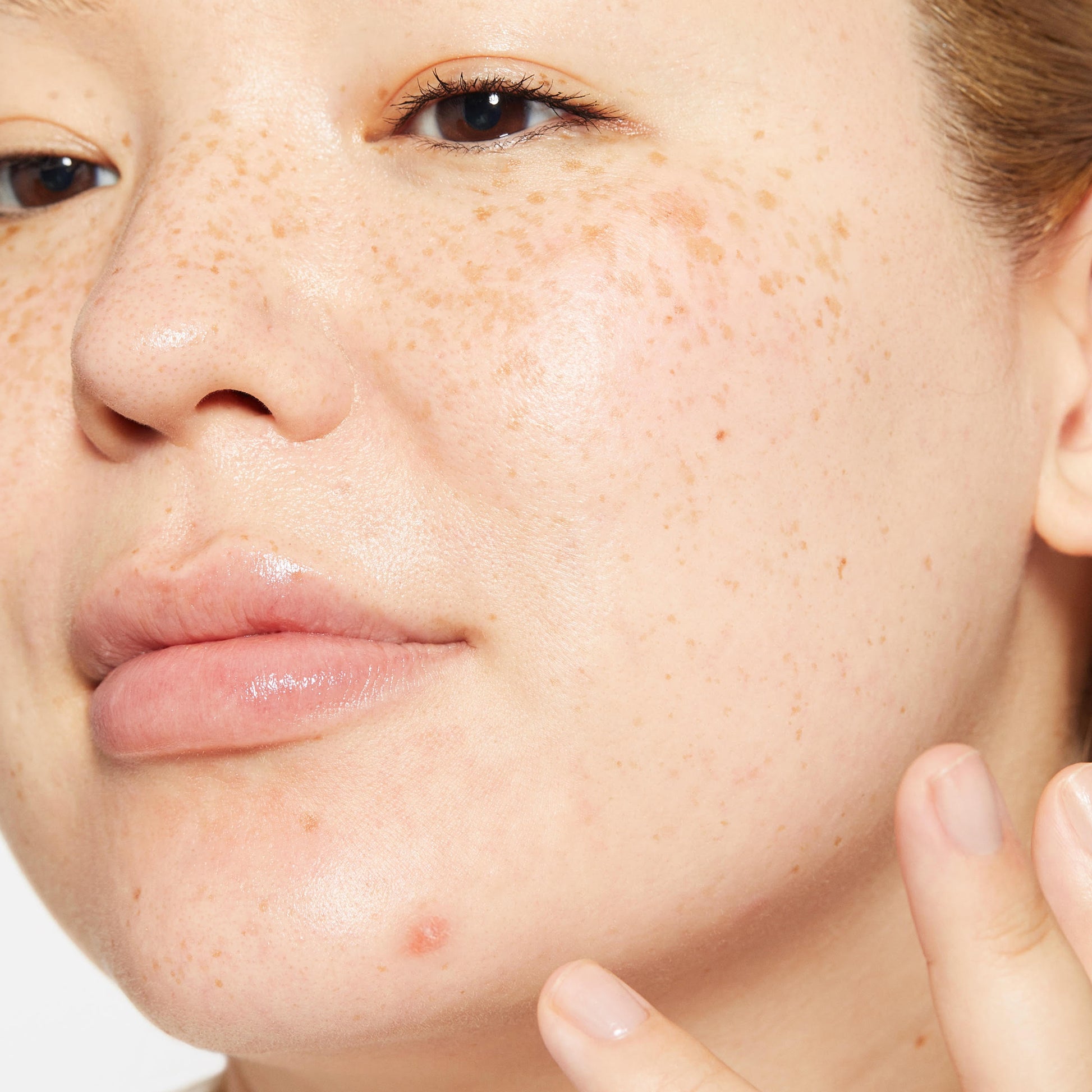 Types Of Spots And How To Treat Them – Dermalogica UK